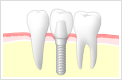 インプラント